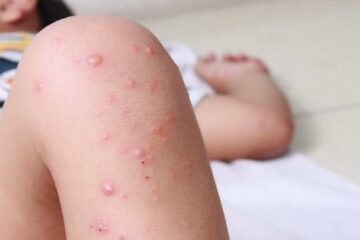 Baja vacunación infantil y posible fin de requisitos en Florida elevan el riesgo de una epidemia de sarampión en EE. UU., según estudio
